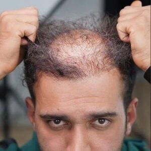 Achieve Thick and Healthy Hair with Crown Transplants