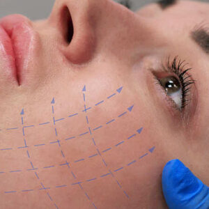 Can Thread Lift Help with Drooping Eyebrows