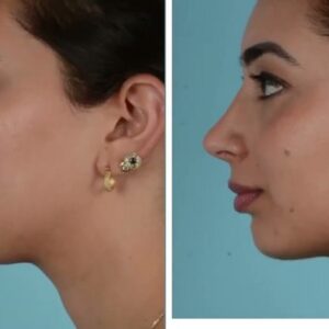 عملية تصغير الذقن في الرياض