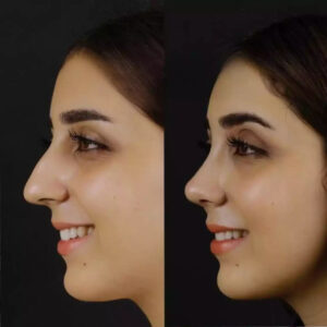 Septoplasty in dubai