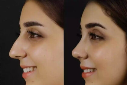 Septoplasty in dubai