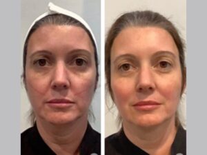 Achieve Glowing Skin Through Thread Lift Treatments at the Best Aesthetic Clinic in Dubai