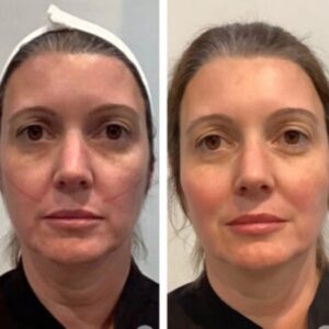 Achieve Glowing Skin Through Thread Lift Treatments at the Best Aesthetic Clinic in Dubai