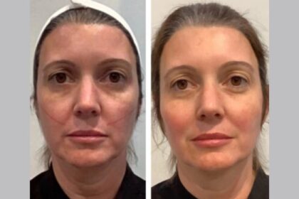 Achieve Glowing Skin Through Thread Lift Treatments at the Best Aesthetic Clinic in Dubai