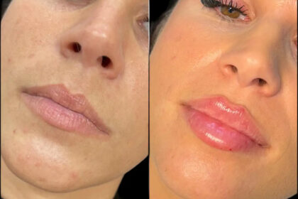 fillers in Dubai