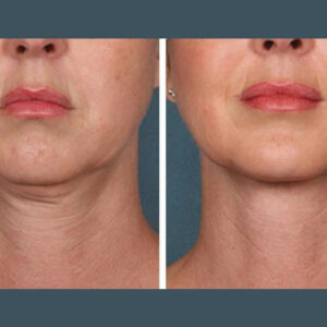 PRP Treatment in Dubai