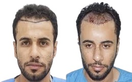 زراعة الشعر في الرياض