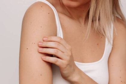 How Safe is Benign Mole Removal Treatment for Delicate Areas