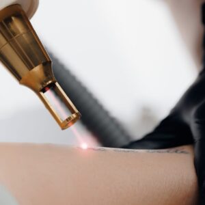 Laser Tattoo Removal Restore Your Natural Skin