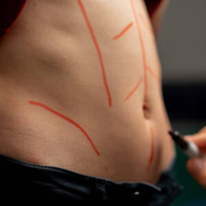 Mini Abdominoplasty Combining Aesthetics and Safety