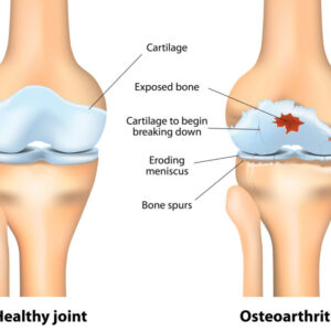 Osteoarthritis ICD 10