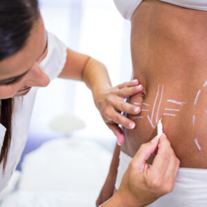 Liposuction Surgery