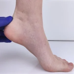 Best Medications for Treating Foot Disorders in Edinburgh