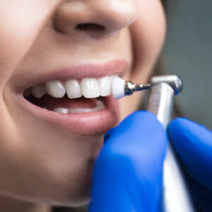 Mouth Dental Implants