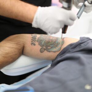 Advanced PicoSure Laser Treatments for Complete Tattoo Removal