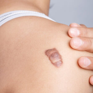 Burn Reconstructive Surgery A New Beginning for Survivors