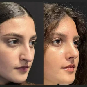 best septoplasty surgeon in dubai