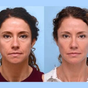 Look Younger Instantly with Thread Lift Treatment in Dubai