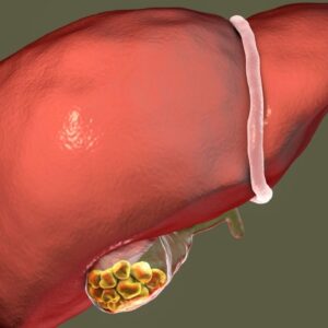 How Gall Bladder Stones Are Removed