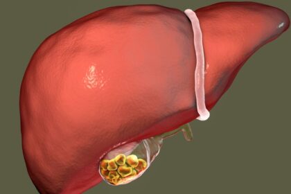 How Gall Bladder Stones Are Removed