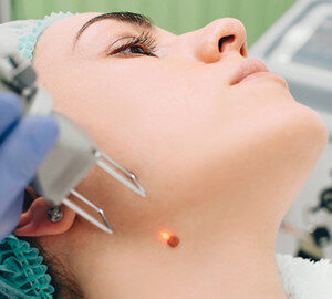 Mole Removal Safe Dermatology Procedures