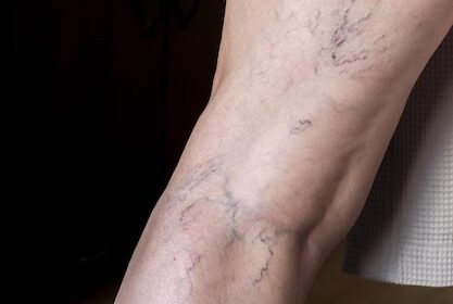 Reduce Vein Visibility with Sclerotherapy