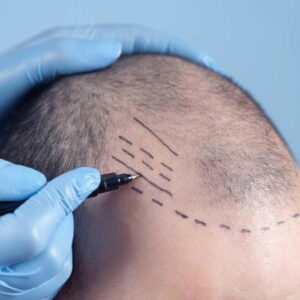 Why FUE Hair Transplant Is the Preferred Choice