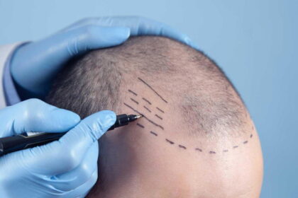 Why FUE Hair Transplant Is the Preferred Choice