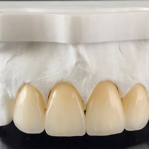 Zirconia Crown Dubai