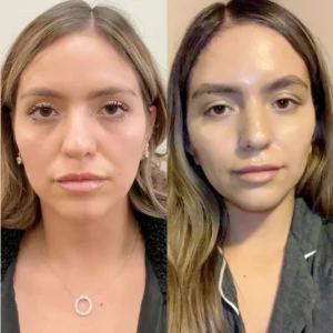 Natural-Looking Results with Thread Lift at the Best Aesthetic Clinic in Dubai