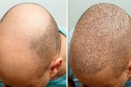 زراعة الشعر في الرياض