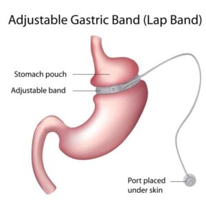 Minimally Invasive Gastric Banding Options