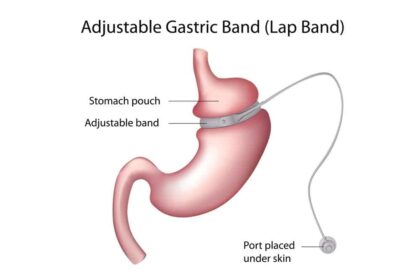 Minimally Invasive Gastric Banding Options