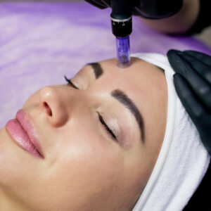 Non-Surgical Skin Tightening with Microneedling
