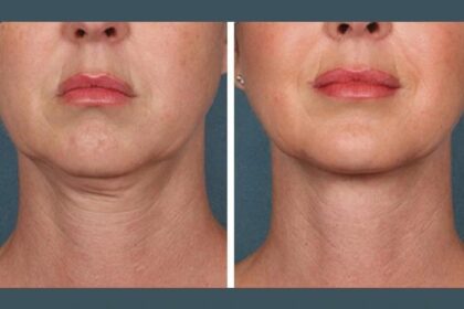 PRP Treatment in Dubai