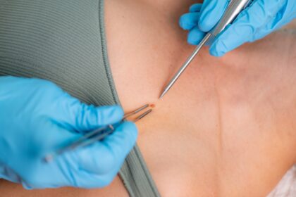 Safe Dermatology Solutions for Warts Removal