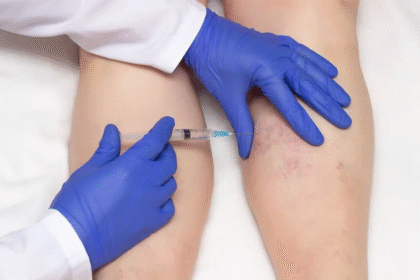 Spider Vein Solutions with Sclerotherapy