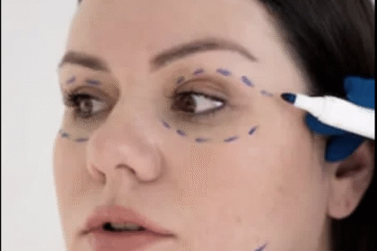 Face Liposuction In Dubai