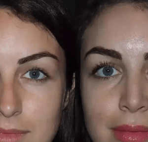 best rhinoplasty sugeon in dubai