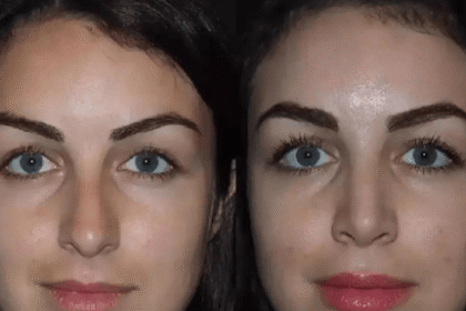 best rhinoplasty sugeon in dubai