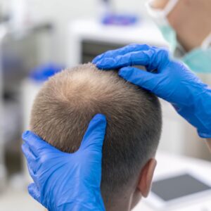 زراعة الشعر في الرياض