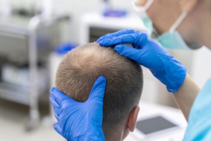 زراعة الشعر في الرياض