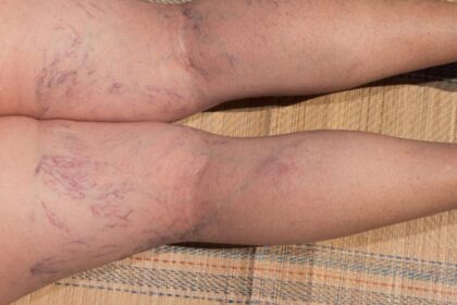 Get Clear Skin with Spider Vein Therapy