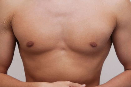 Gynecomastia Surgery What You Need to Know